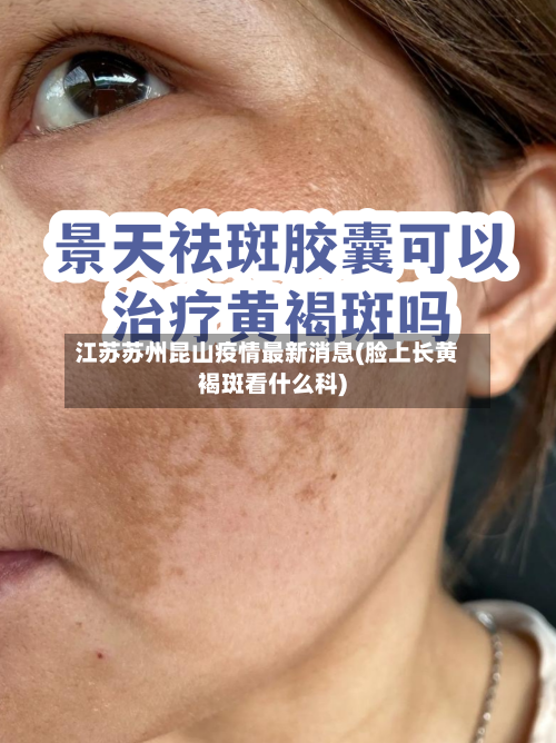 江苏苏州昆山疫情最新消息(脸上长黄褐斑看什么科)